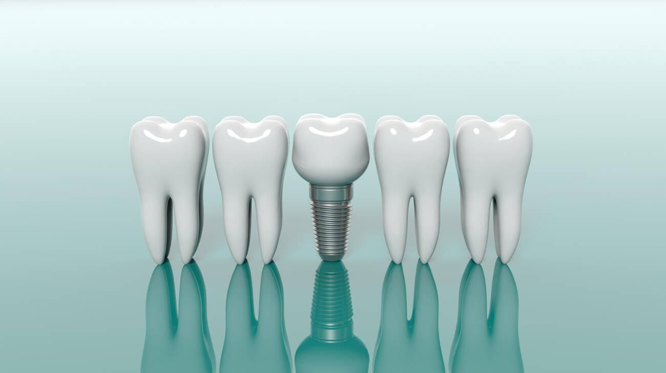 How Long Does a Tooth Implant Last?